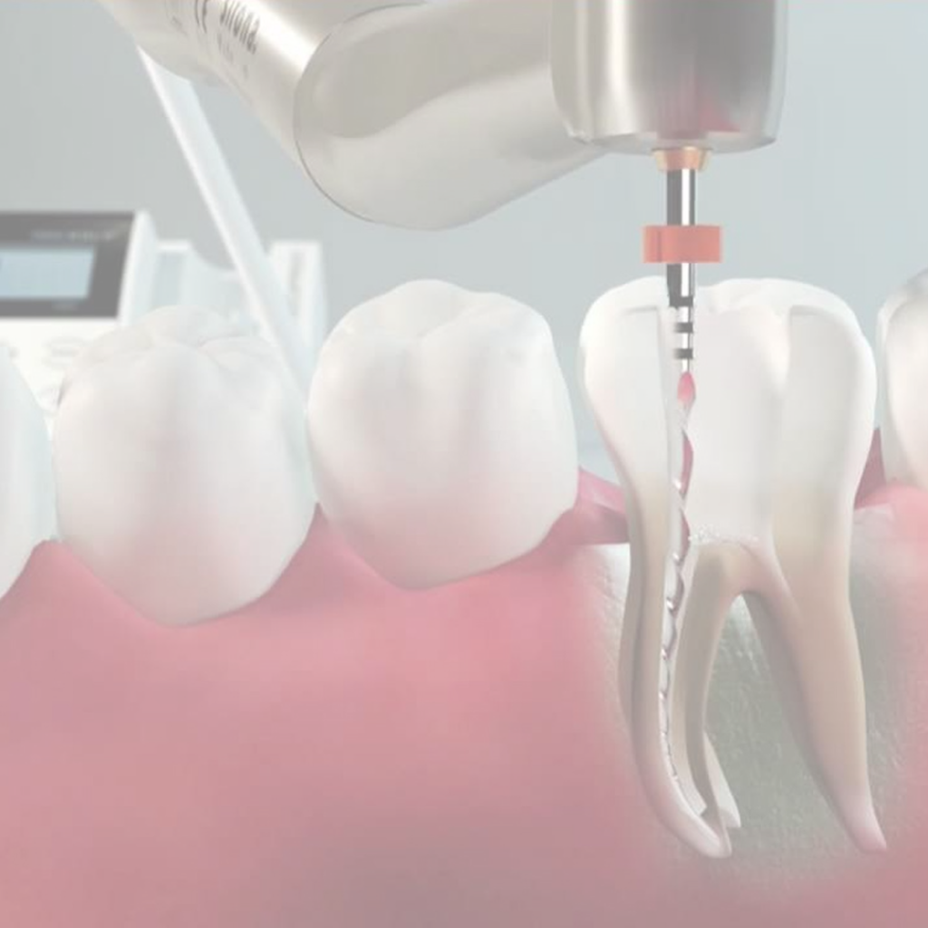 108 servico tratamento de canal hover 1024x1024 - Tratamento de Canal - Endodontia