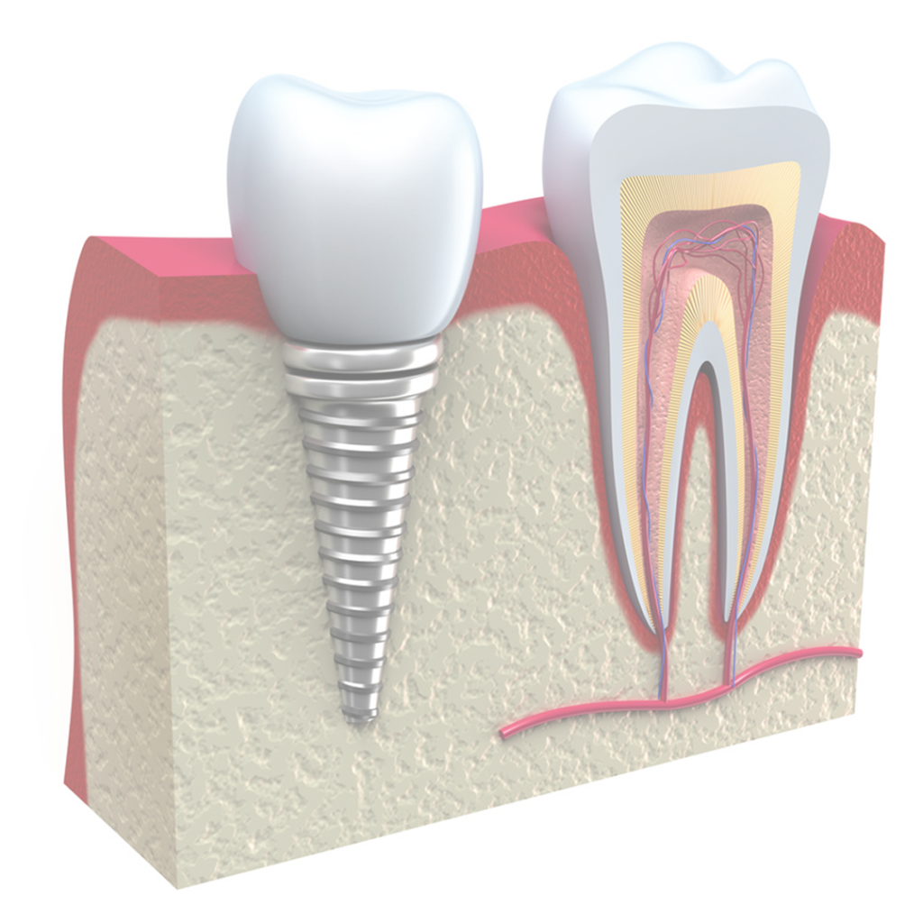 111 servico implantes dentários hover 1024x1024 - Implantes Dentários