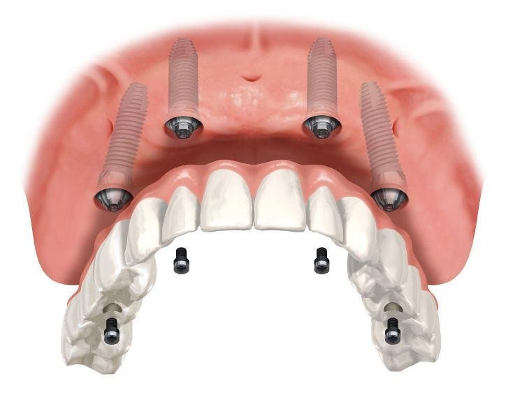 58 protocolo Superiorr - Prótese Protocolo Sobre Implantes