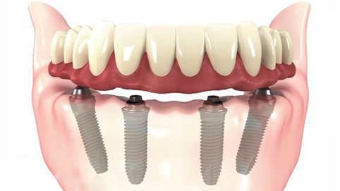 59 Protocolo Inferiorr - Prótese Protocolo Sobre Implantes