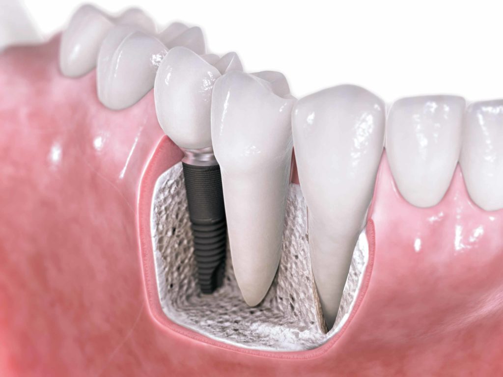 76 1024x768 - Implantes Dentários