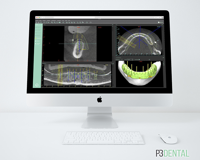 89 - Cirurgia de Implantes Guiada por Computador