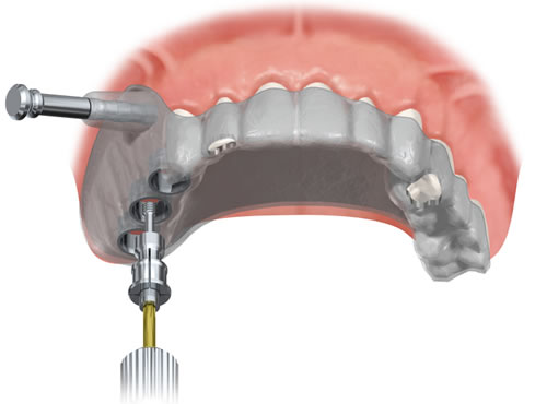 90 - Cirurgia de Implantes Guiada por Computador