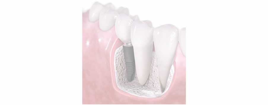 Blog 03 - Saiba tudo sobre Implantes Dentários